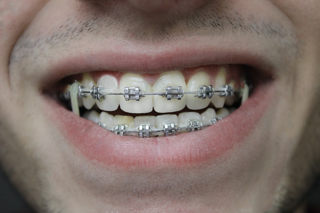 Ankara Ortodonti Kliniği - Invisalign Nedir?