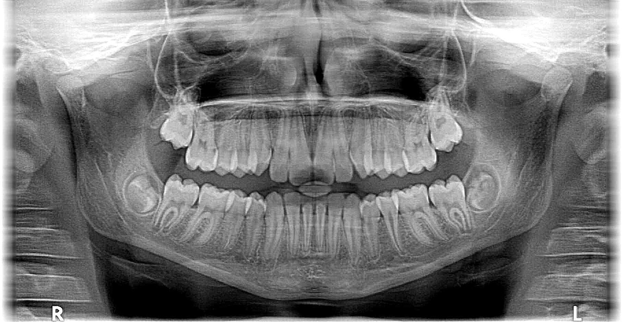 Ankara Şeffaf Plak Tedavisi - Invisalign Plaklarının Temizlenmesinde Dil Temizleyici Kullanımının Önemi