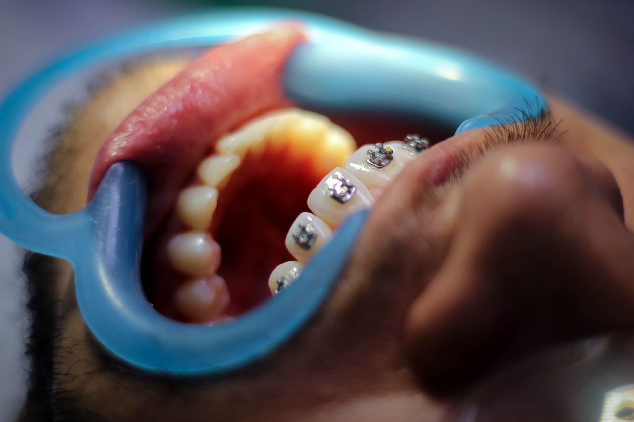 Ankara Şeffaf Plak - Invisalign ve Porselen Tel Tedavisi