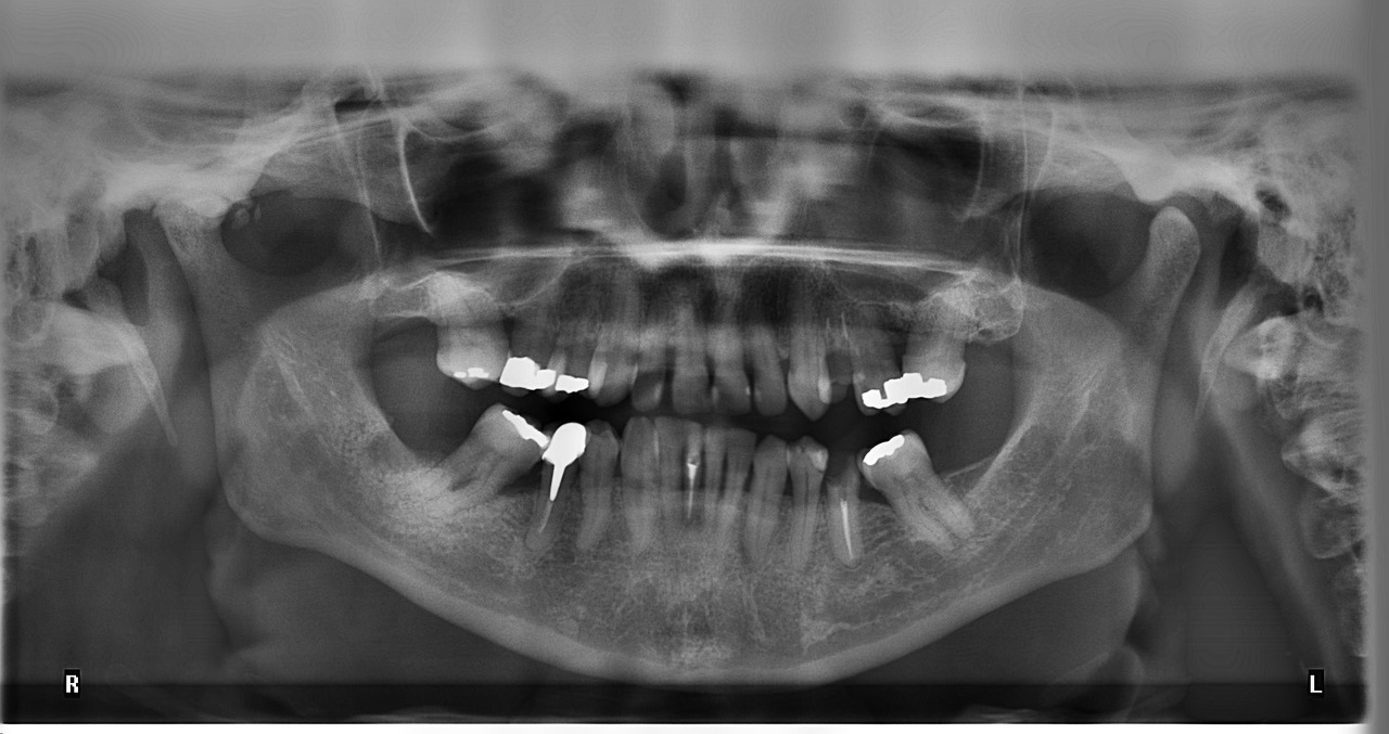 Ankara Şeffaf Plak Tedavisi - İnvisalign Tedavisinde Röntgen ve Kontrollerin Önemi: 5 Neden 