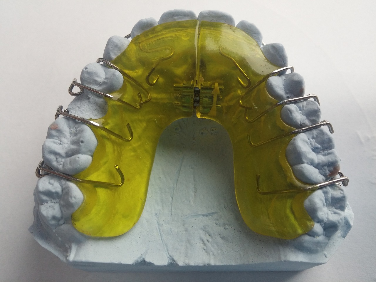 Ankara İnvisalign Klinik - Invisalign ile İleriye Doğru Çıkıklık Problemlerinin Giderilmesi